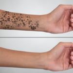 woman with arm tattoo before and after
