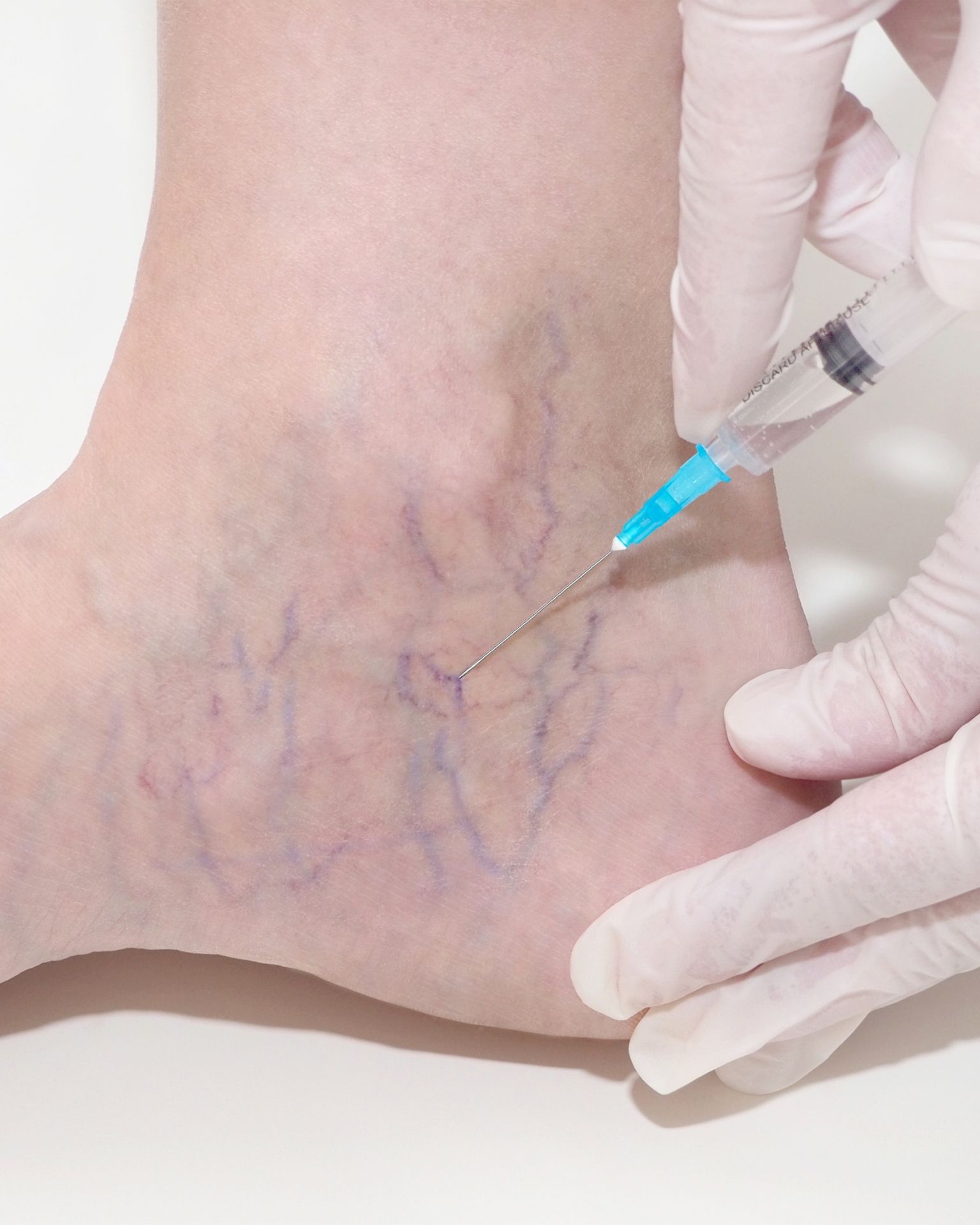 Vein Injection - Sclerotherapy - Meridian Cosmetic